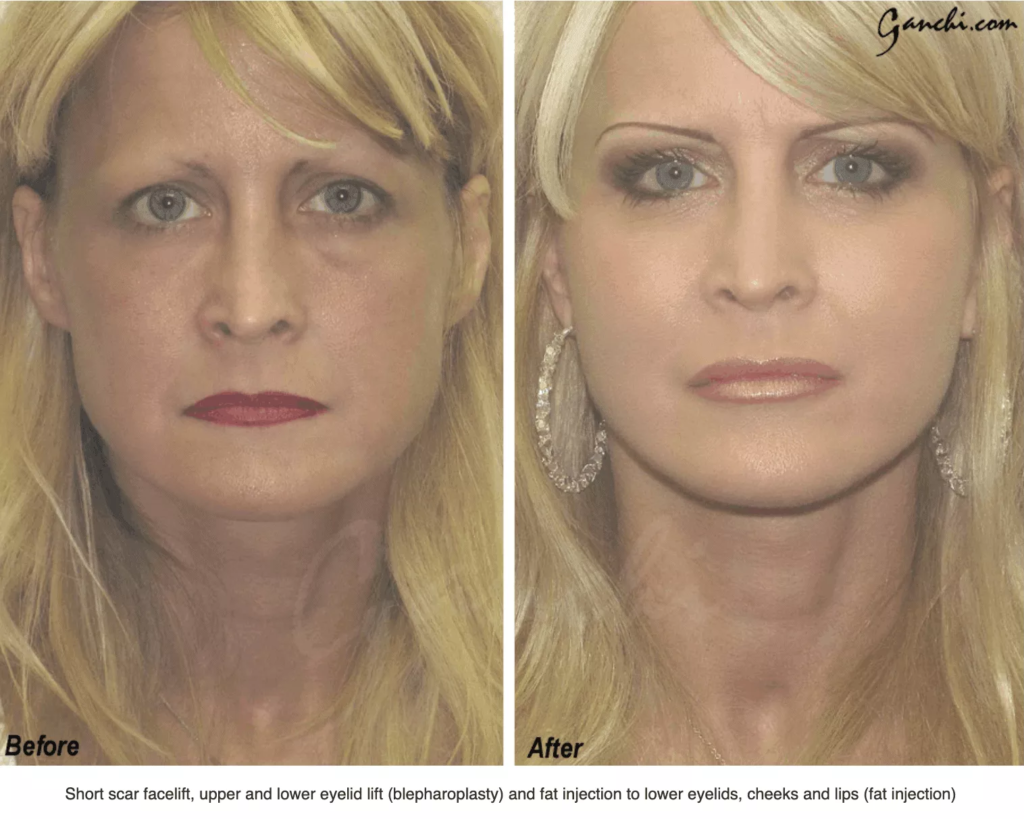 Facial Plastic Surgery, Bandage after a laser face lift and