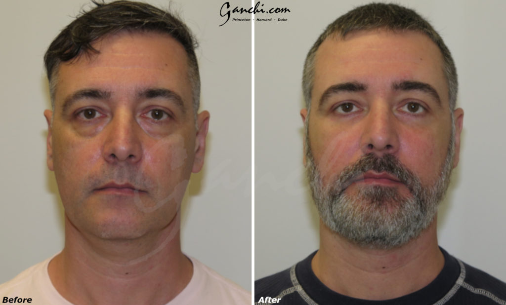 Eyelid Lift Before and After Photo by Ganchi Plastic Surgery in Northern New Jersey