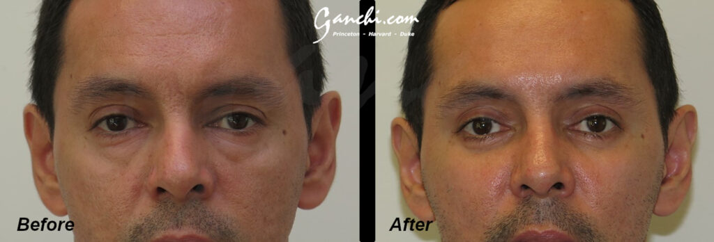 Eyelid Lift Before and After Photo by Ganchi Plastic Surgery in Northern New Jersey