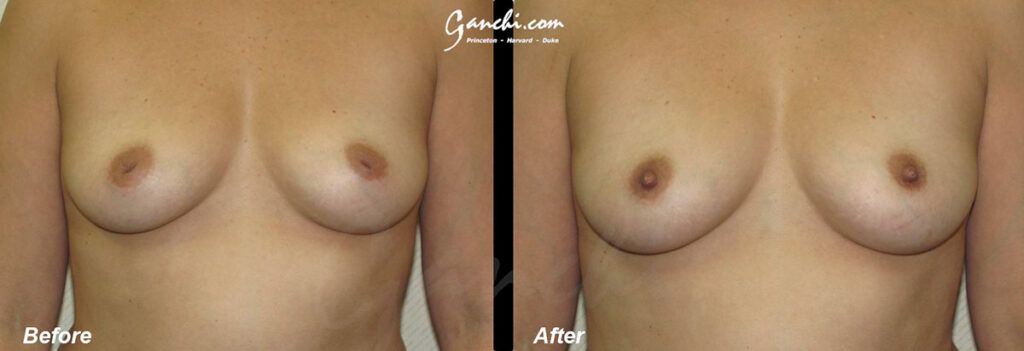 Nipple Surgery Before and After Photo by Ganchi Plastic Surgery in Northern New Jersey