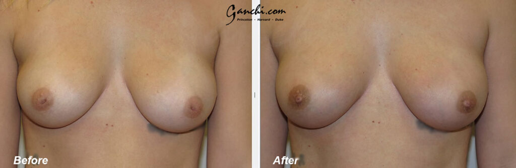 Nipple Surgery Before and After Photo by Ganchi Plastic Surgery in Northern New Jersey