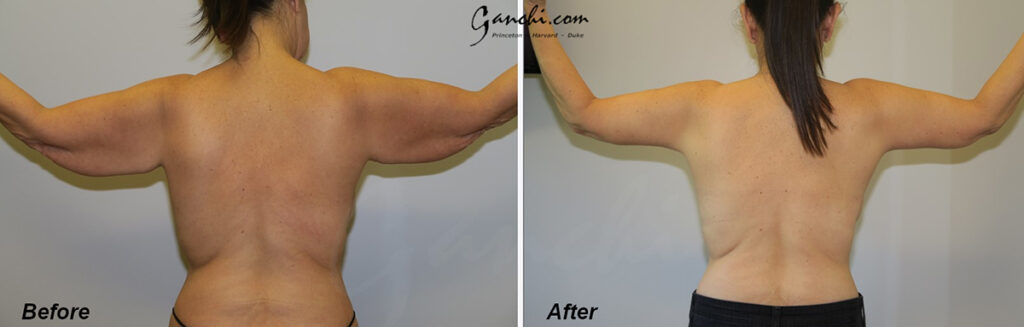 Arm Lift Before and After Photo by Ganchi Plastic Surgery in Northern New Jersey